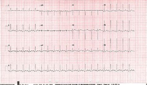 boardline ecg|borderline ecg betekenis.